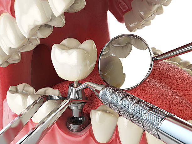 Best Emergency Tooth Extraction in Glenwood, MN